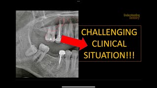 How to solve this clinical case OPG interpretation radiology radiographic interpretation x ray [upl. by Ratna967]