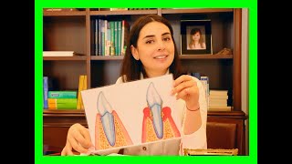 Periodontitis nedir  Küretaj tedavisi kimlere ve nasıl yapılır [upl. by Hajile]