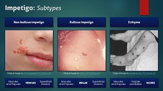 Impetigo Subtypes [upl. by Akyssej]