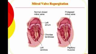 Valvular Disease [upl. by Gillette]