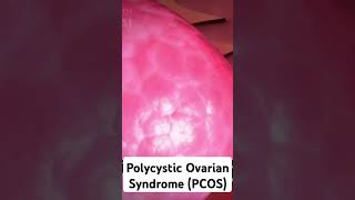 Polycystic Ovarian Syndrome PCOS video on my profile pcos polycysticovarysyndrome infertility [upl. by Elmira660]