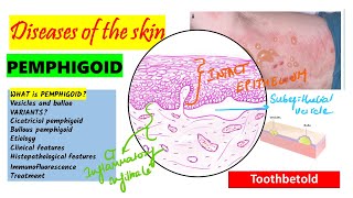 Pemphigoid Causes pathogenesis Types Histopathology Treatment  Pemphigus vs Pemphigoid [upl. by Atahs]