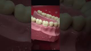 Dental crown preparation part 2 proximal surface reduction teeth teethstreet dental dentaltip [upl. by Adamsen]