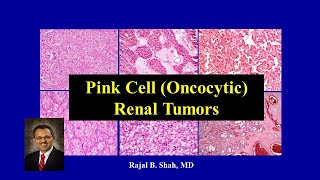 A Dummies Guide to Pink Cell Oncocytic Renal Tumors [upl. by Dihgirb977]