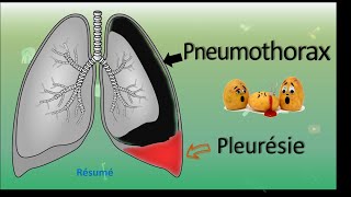 💨 Pneumothorax 🆚 Pleurésie 💧  Résumé  PneumoPhtisiologie [upl. by Eudocia873]