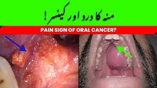 Signs of Oral Cancer  Mouth Pain and Cancer  Case Discussion  UrduHindi [upl. by Honig]