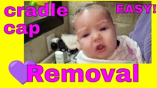 Revealing the Secret to Removing Cradle Cap in Seconds [upl. by Aimekahs]