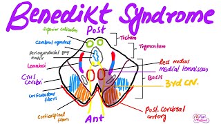 Benedikt syndromeMade easy for USMLEPlabFCPS medicine [upl. by Theall]