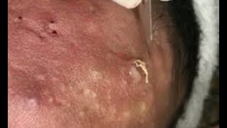 Pele com muita Acne  Limpeza de Pele Profunda  Clínica  Centro estética [upl. by Shandy]