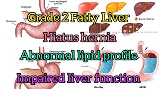 Acidity Acid refluxGas and Fatty liver treatment [upl. by Alarice]