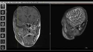 NF2 Ewing sarcoma [upl. by Analad]