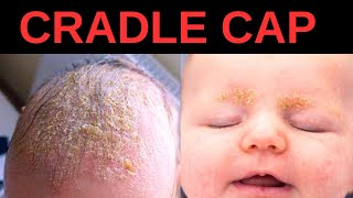 What is Cradle Cap Symptoms Causes Treatment [upl. by Kumler]