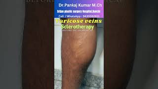 15824 Foam Sclerotherapy treatment for varicose veins Varicose veins treatment before SSC GD [upl. by Antin450]