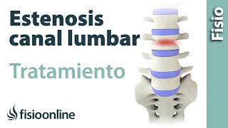 Estenosis de canal lumbar  Causas síntomas y tratamiento [upl. by Schwenk]