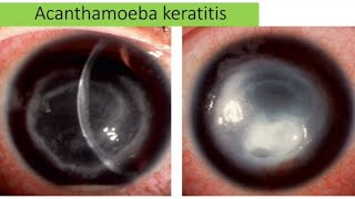 Acanthamoeba keratitis  causes sign clinical pictures management [upl. by Verine]