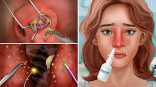 ASMR Causes and The best treatment of sinuses nasal discharge [upl. by Agathe713]