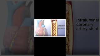 Angioplasty Procedure Animation VideoWhat are the steps of angioplasty [upl. by Akihc]