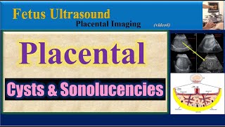 Fetus Ultrasound Placental Cysts amp Sonolucencies [upl. by Lesirg268]