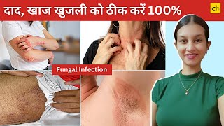 Fungal Infection क्या होता है Causes Symptoms and Treatment  Credihealth [upl. by Noirret]