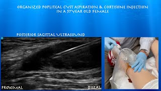 Ultrasound Guided Complex Popliteal Cyst Aspiration and Cortisone Injection by probeultrasound [upl. by Padgett18]