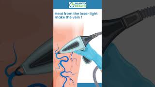 Varicose Veins Treatment Procedure  Glamyo Health [upl. by Noiztneb]