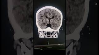 Corpus Callosum Agenesis  Radiology [upl. by Nosauq183]