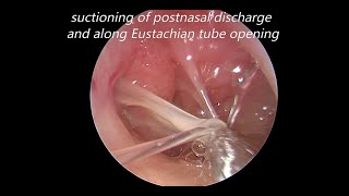 Endoscopic Myringotomy Suctioning of Middle Ear Mucous and Grommet Insertion [upl. by Desmond385]