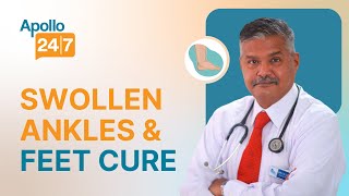 Swollen Ankles amp Feet Causes and Cure  Dr S K Sahoo  Apollo 247 [upl. by Yras]