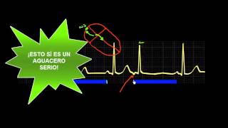 CURSO DE ELECTROCARDIOGRAFIA 47  EXTRASÍSTOLES SUPRAVENTRICULARES [upl. by Nnaxor230]