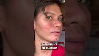 TCA CROSS FOR ACNE SCARS  TCA CROSS PHILIPPINES diy trending acnescarstreatment [upl. by Averell684]