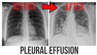 PLEURAL CALCIFICATION  on CHEST X RAY [upl. by Ramraj]