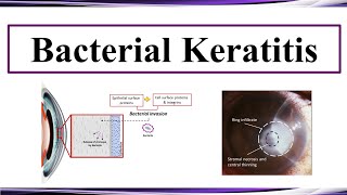 Bacterial Keratitis [upl. by Cormac]