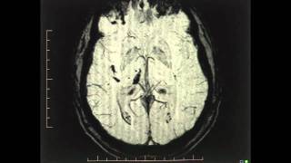 Susceptibility Weighted Imaging SWI  Canadian Magnetic Imaging [upl. by Bassett83]