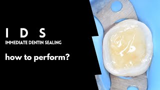 Immediate Dentin sealing  How to perform  Full protocol [upl. by Eibbed584]