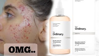 I Tested The Ordinary Glycolic Acid Toner Every Day For A Week  These are my thoughts [upl. by Coben178]