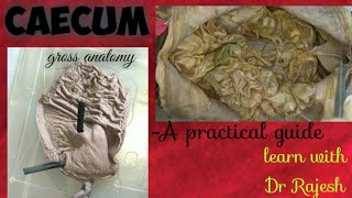 CAECUM  Specimen demo [upl. by Eilah]