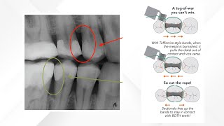 Sectional Matrix System versus TofflemireStyle System [upl. by Uzzi]