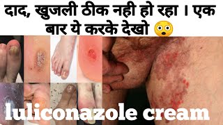 Luliconazole cream  Luliconazole cream 1 ww uses in hindi [upl. by Samau]