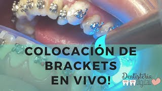 Colocación de Brackets en VIVO  Putting on Braces  LIVE [upl. by Akilaz]