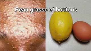 Comment se débarrasser dune peau grasse et de boutons sévères  Utilisez du citron  blanc dœuf [upl. by Eiltan]