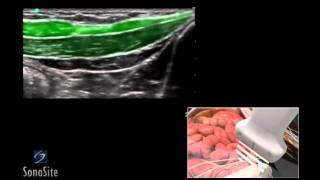 How To Ilioinguinal and Iliohypogastric Regional Nerve Block 3D Video [upl. by Charin]