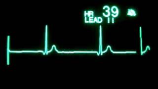 Junctional Bradycardia [upl. by Deeraf]