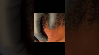 Stitch Removal [upl. by Eibloc]