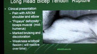 Long Head Biceps Tendon Rupture [upl. by Korfonta935]