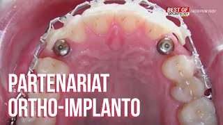 L’outil orthodontique quel partenariat avec l’implantologie [upl. by Alaik390]