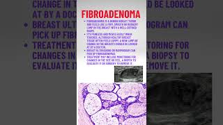 Fibroadenoma pathologyacademy draditikumar mbbs neet neetpg [upl. by Lennad]