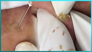 Big Cystic Acne Blackheads Extraction Blackheads amp Milia Whiteheads Removal Pimple Popping [upl. by Cowey]