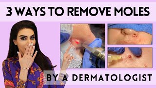 3 Ways to Remove Moles by a Dermatologist [upl. by Opportuna]