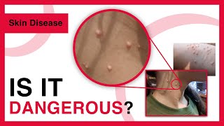 Molluscum contagiosum  Symptoms Risk factors Treatment Prevention  Dermatology [upl. by Ntsyrk]