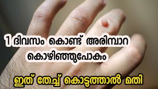 അരിമ്പാറ കളയാം ഒറ്റമൂലിയിലൂടെ  How To Remove Warts At Home  Warts Removel Home Remedy [upl. by Arie]